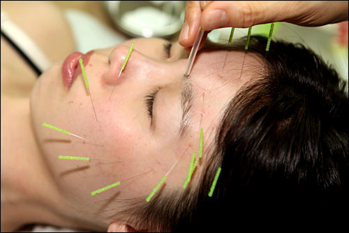 椿漢方クリニック で美容鍼にチャレンジ 韓国美容医療体験レポート 韓国旅行 コネスト